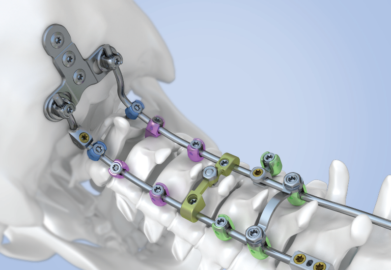 ANAX™ OCT Spinal System